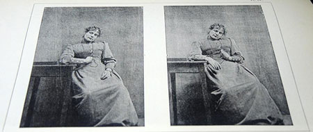 Figure 7 : Transfert de contracture chez une hystérique (© Musée de l’AP-HP/ Photo : HCS)